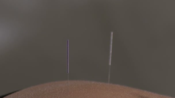 Aiguilles Acupuncteur Dopées Dans Dos Une Femme — Video