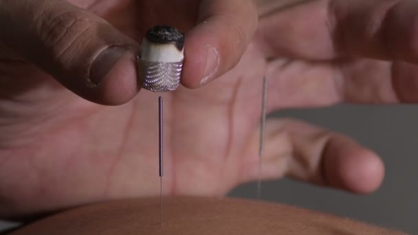 Acupuncturist Applying Moxa Needle Acupuncture — Stockvideo