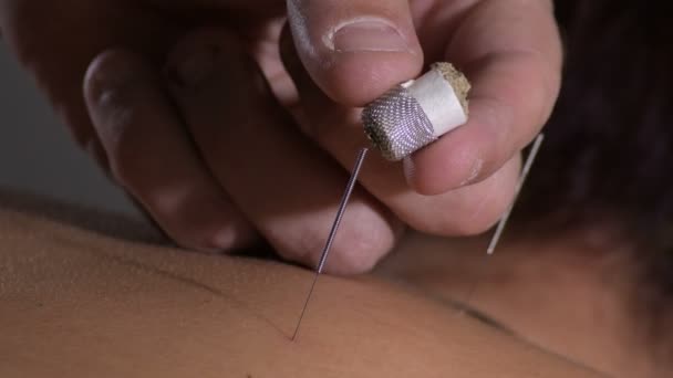 女性患者の背中の針療法にモキサを適用します — ストック動画