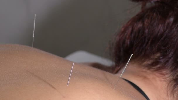 Acupuncture Needles Spike Back Woman Patient — Stock Video