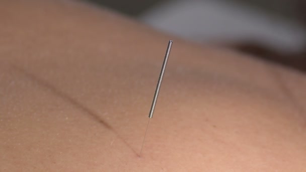 女性患者の背中に鍼治療針のスパイク — ストック動画