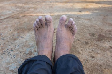 Ayaklarını iliklerine kadar uzun su sonra buruşuk.