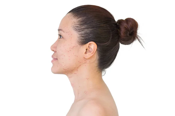 Burn Spots Scabs Laser Treatment Acne Skin Freckles Freckles Dark — Stock Photo, Image