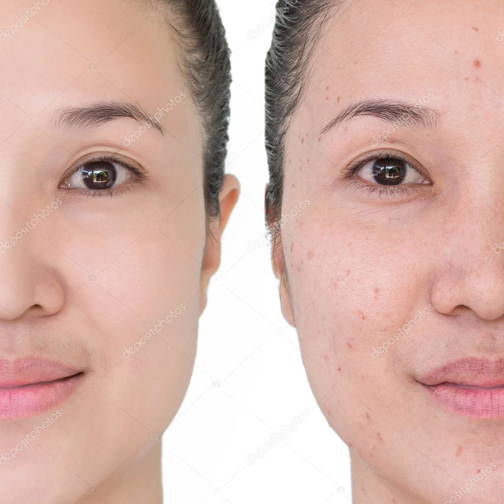 Beautiful young woman with and without aging singes, wrinkles, blemishes, mole. Before and after laser treatment or plastic procedure, anti-age therapy concept.