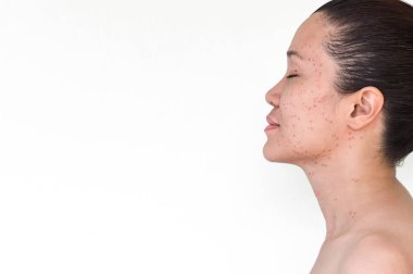 Lazer tedavi sivilce deri, çiller, çiller ve yüz ve boyun Asyalı kadın koyu lekeler noktalar veya grev kırıcılar yazma.