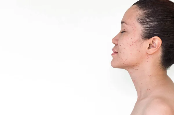 Burn Spots Scabs Laser Treatment Acne Skin Freckles Freckles Dark — Stock Photo, Image
