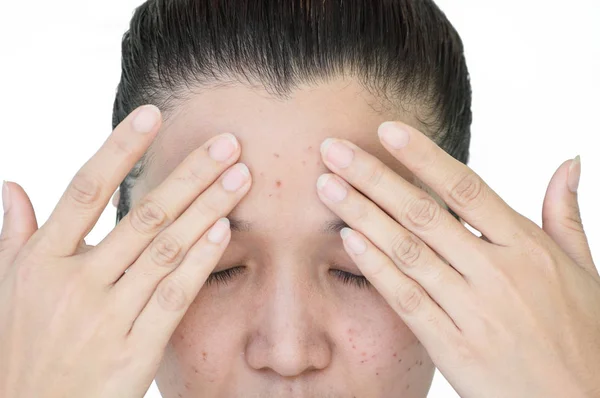 激光治疗烧伤斑点或疤痕亚洲妇女的脸部和颈部粉刺皮肤 雀斑和黑斑 — 图库照片