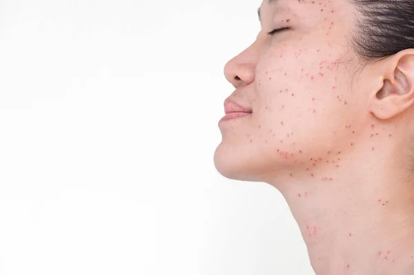 Burn Spots Scabs Laser Treatment Acne Skin Freckles Freckles Dark — Stock Photo, Image
