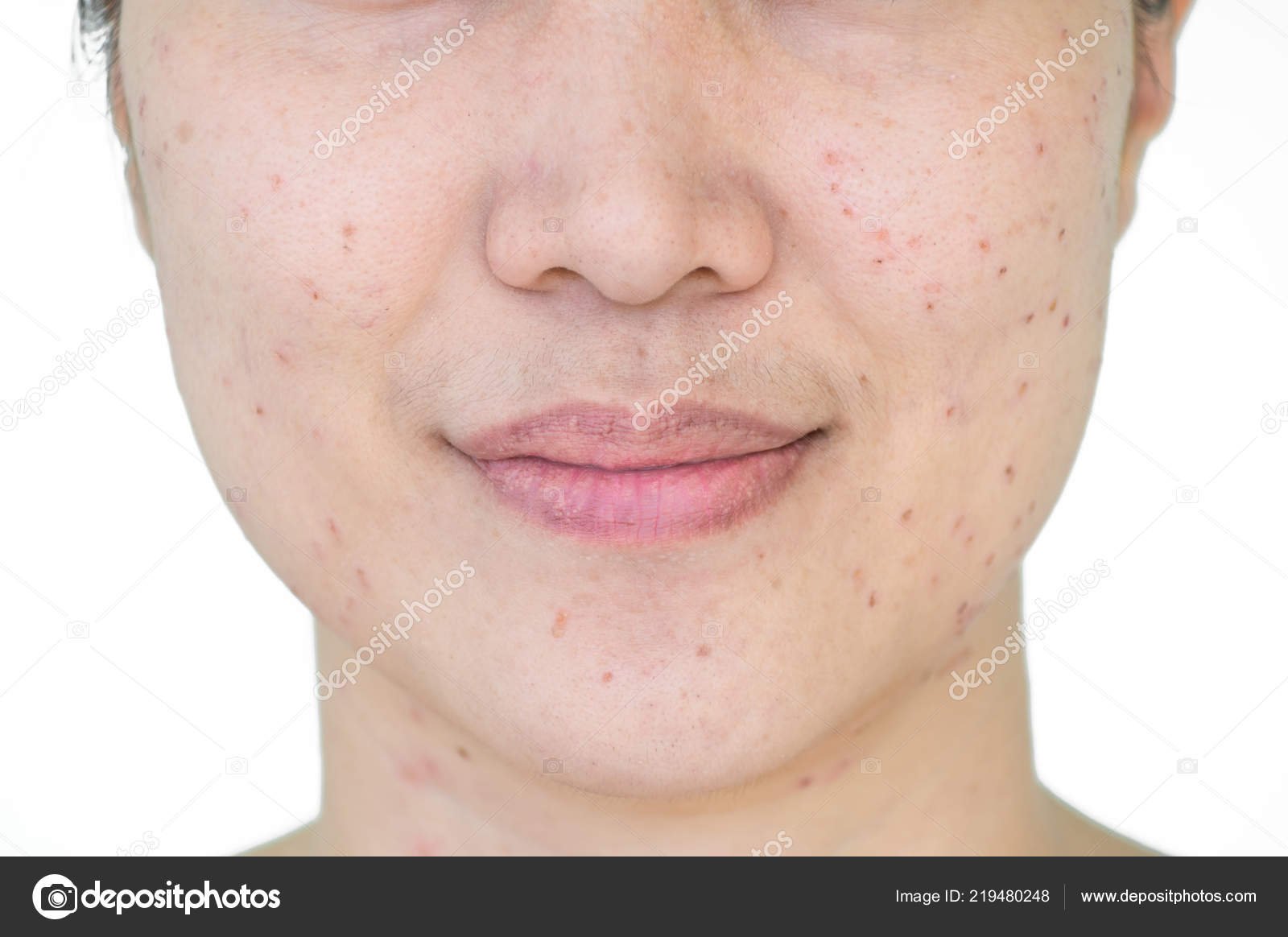 Burn Spots Scabs Laser Treatment Acne Skin Freckles Freckles Dark