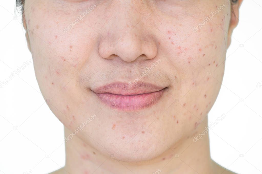 Manchas de quemaduras o costras de tratamiento láser acné piel, pecas