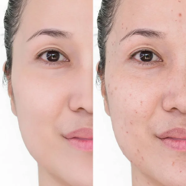 Beautiful Young Woman Aging Singes Wrinkles Blemishes Mole Laser Treatment — Stock Photo, Image