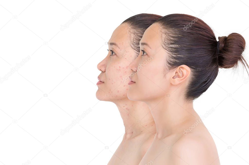 Beautiful young woman with and without aging singes, wrinkles, blemishes, mole. Before and after laser treatment or plastic procedure, anti-age therapy concept.