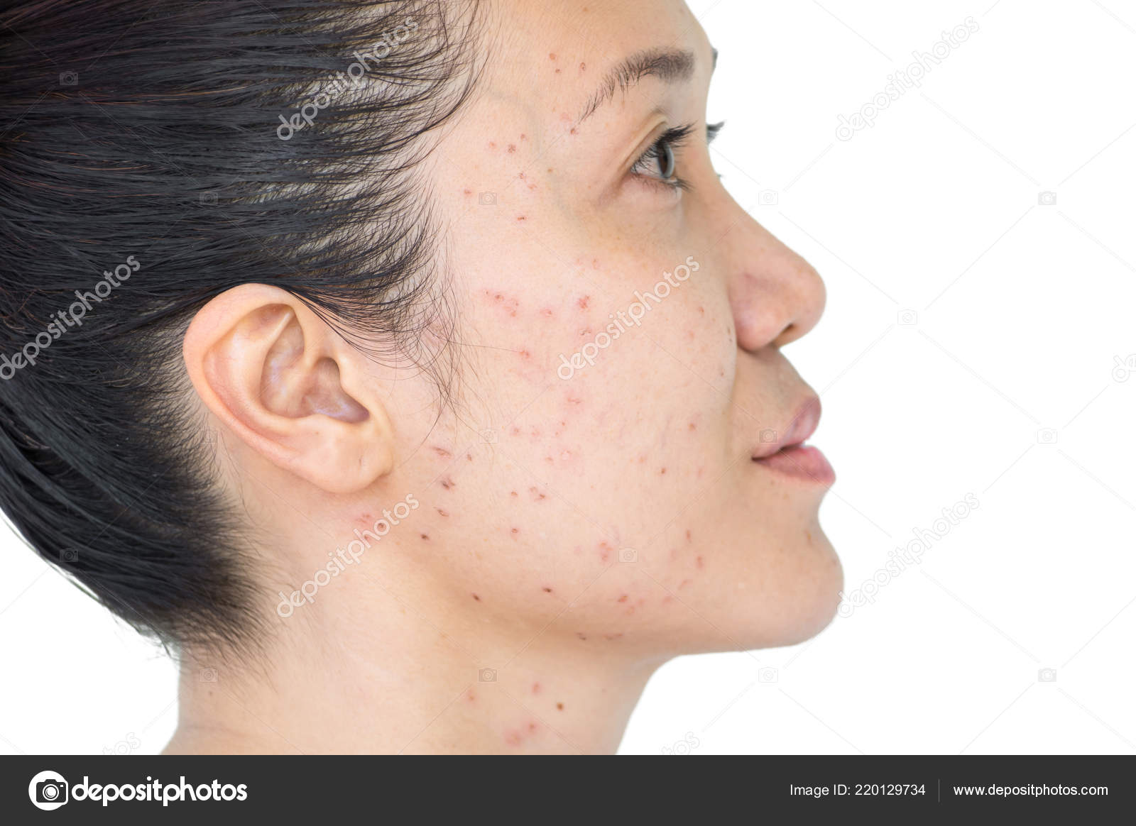Tratamiento para quitar manchas por acne