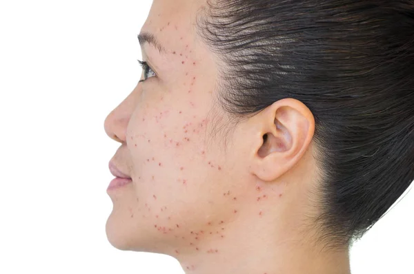 Burn Spots Scabs Laser Treatment Acne Skin Freckles Freckles Dark — Stock Photo, Image