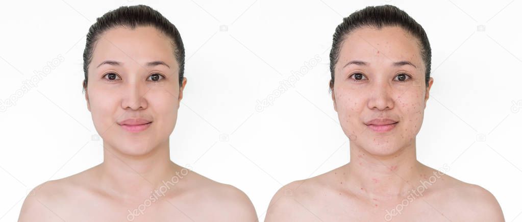 Beautiful young woman with and without aging singes, wrinkles, blemishes, mole. Before and after laser treatment or plastic procedure, anti-age therapy concept.