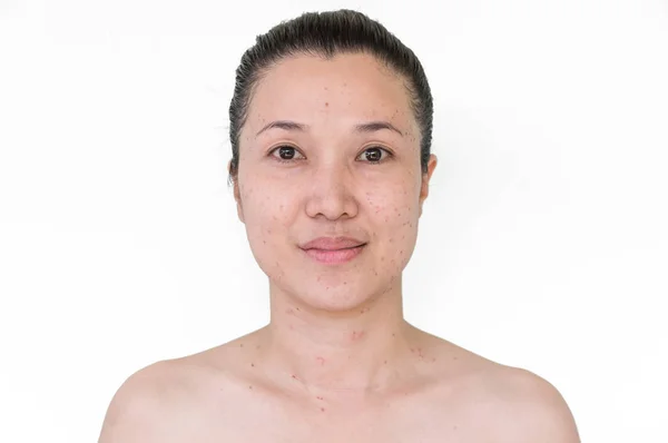 레이저 여드름 아시아 여자의 반점에서 Scabs를 — 스톡 사진