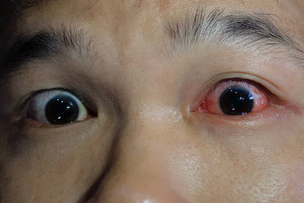 Kızarıklık Inflamasyon Konjonktivit Gözleriyle — Stok fotoğraf