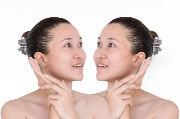 Beautiful Young Woman Aging Singes Wrinkles Blemishes Mole Laser Treatment — Stock Photo, Image