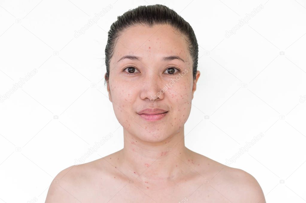 Burn spots or Scabs from laser treatment acne skin, freckles, freckles and dark spots on the face and neck of Asian woman, After burn.