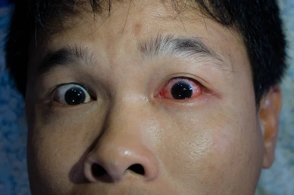 Ojos Con Enrojecimiento Inflamación Conjuntivitis — Foto de Stock