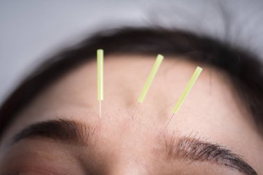 baş akupunktur tedavi geçiren kadın