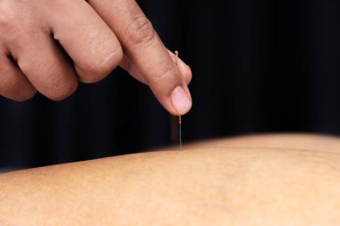 Akupunktur iğne ile bacak tedavisi