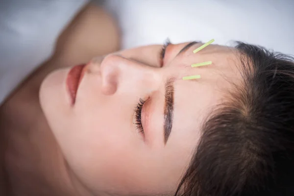 Akupunktúrás kezelés alatt álló nő feje — Stock Fotó