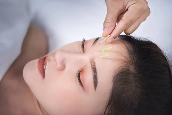 Akupunktúrás kezelés alatt álló nő feje — Stock Fotó