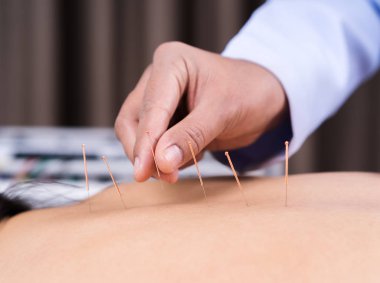 sırta akupunktur tedavisi gören kadın