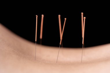 Bir işlem sırasında çelik iğneler ile kadın sırt Yakın çekim