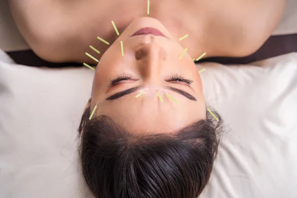 Femme en traitement d'acupuncture sur le visage — Photo