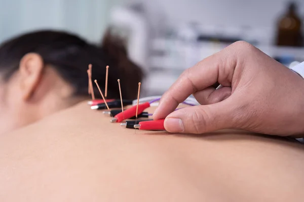 Femme subissant un traitement d'acupuncture avec stimulato électrique — Photo