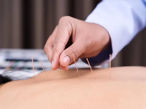 Mulher em tratamento de acupuntura nas costas — Fotografia de Stock