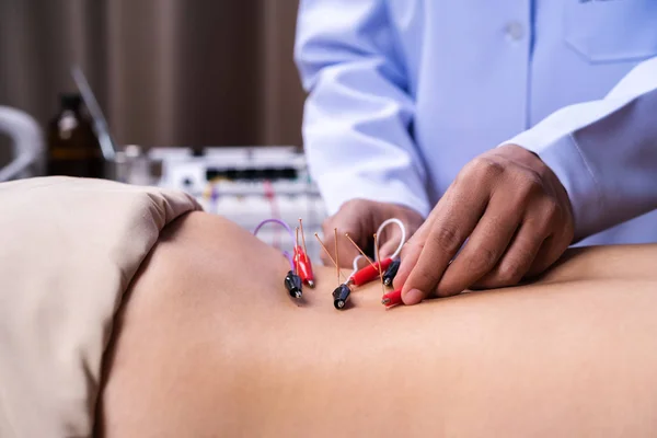 Женщина, проходящая лечение иглоукалыванием с электрическим стимулятором — стоковое фото