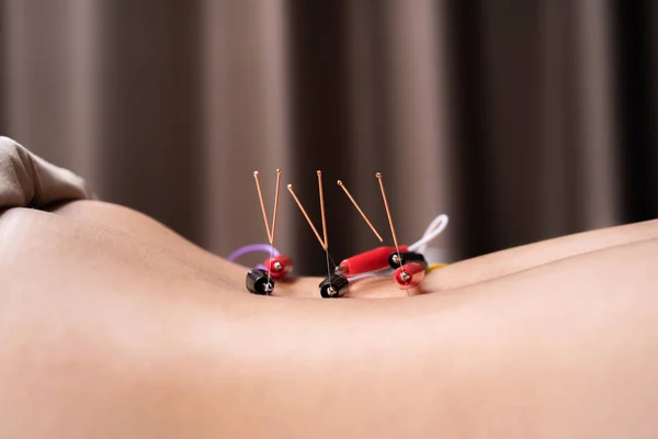 Donna sottoposta a trattamento di agopuntura con stimolo elettrico — Foto Stock