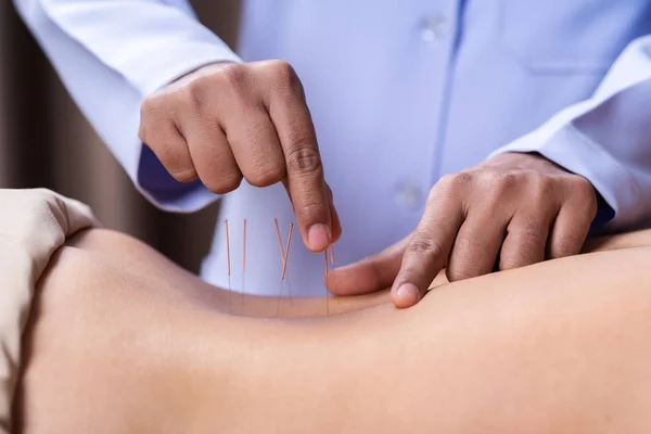 Žena procházející akupunkturou na zádech — Stock fotografie