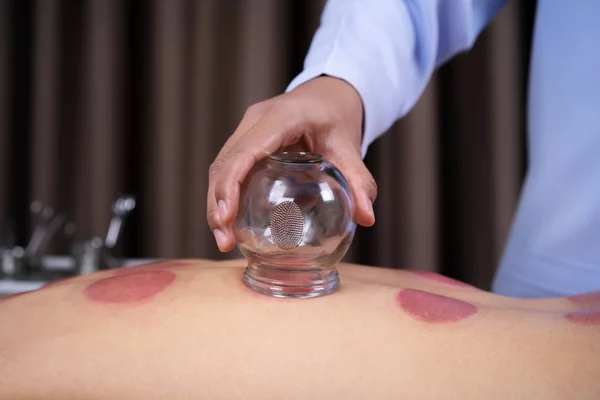 Mulher recebendo tratamento de Cupping nas costas — Fotografia de Stock