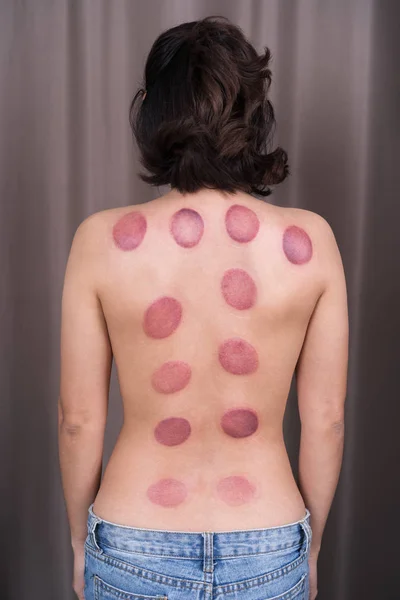 Woman receiving cupping treatment on back — Stock Photo, Image