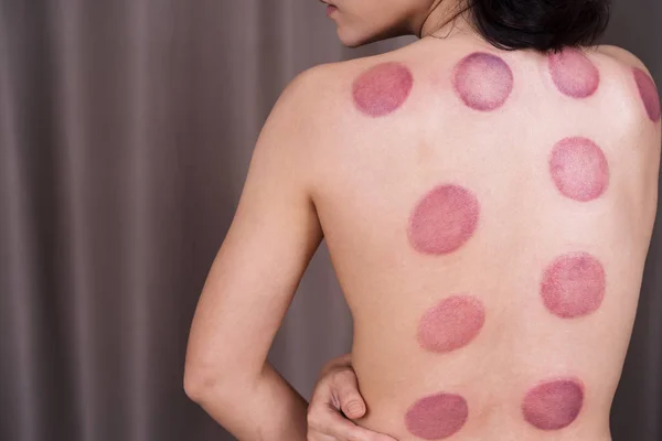 Woman receiving cupping treatment on back — Stock Photo, Image