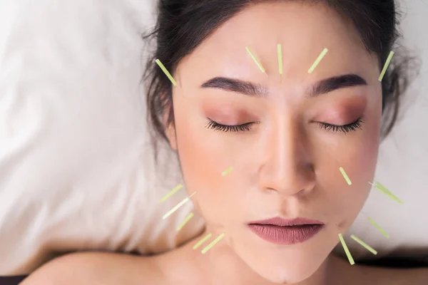 Yüzünde akupunktur tedavisi gören kadın — Stok fotoğraf