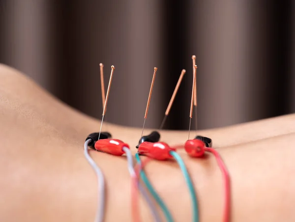 Az elektromos stimulato akupunktúrás kezelés alatt álló nő — Stock Fotó