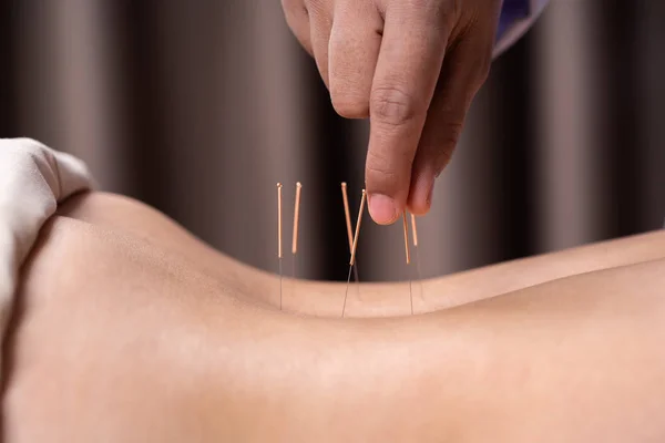 Vrouw ondergaat acupunctuur behandeling op rug — Stockfoto