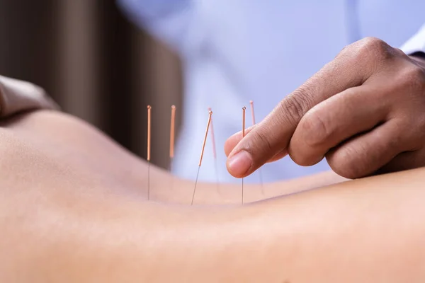 Femme subissant un traitement d'acupuncture sur le dos — Photo