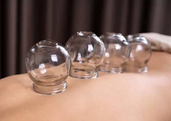 Donna che riceve Cupping trattamento sulla schiena — Foto Stock