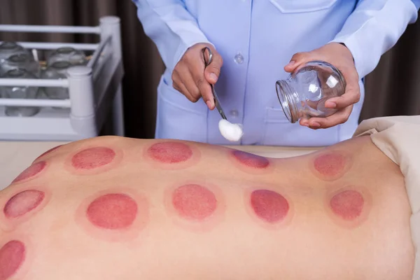 Femme recevant un traitement Cupping sur le dos — Photo