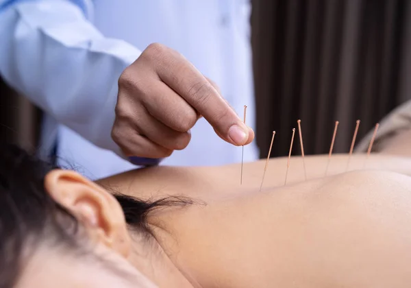 Vrouw ondergaat acupunctuur behandeling op rug — Stockfoto