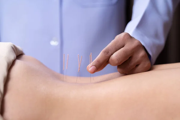 Mujer sometida a tratamiento de acupuntura en la espalda —  Fotos de Stock
