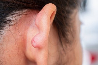 Tıbbi araştırma için klinik bir ortamda gözlemlenen eşsiz kulak yapısı.