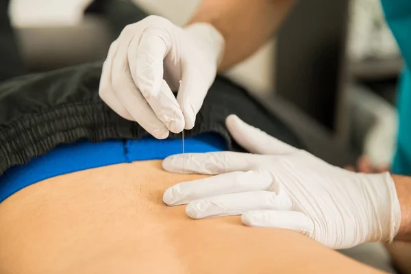 Imagem Recortada Fisioterapeuta Masculino Fazendo Punção Seca Nas Costas Paciente — Fotografia de Stock