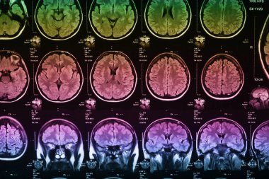 İnsan beyninin, portre resim tıbbi x-ray